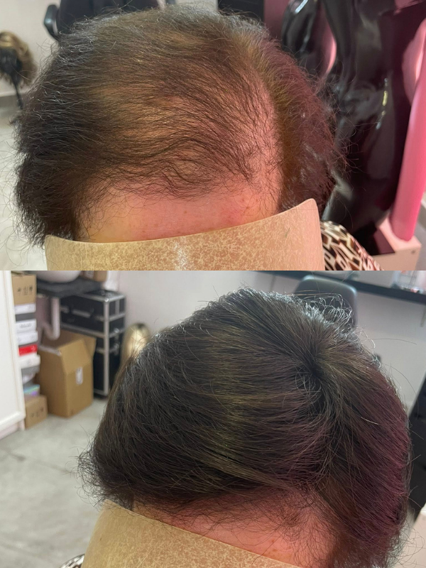 TOPPERS O PRÓTESIS TOPPERS O PRÓTESIS